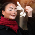 O que é Vitiligo ?