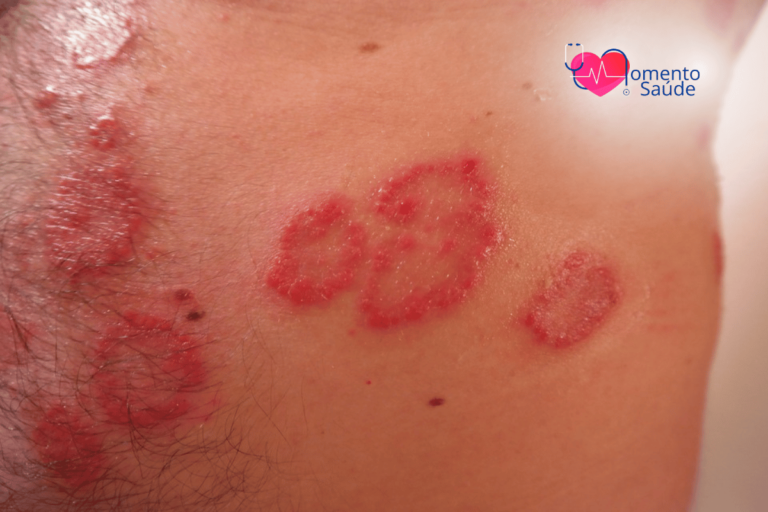 Dermatite atópica, eczema é uma doença inflamatória crônica